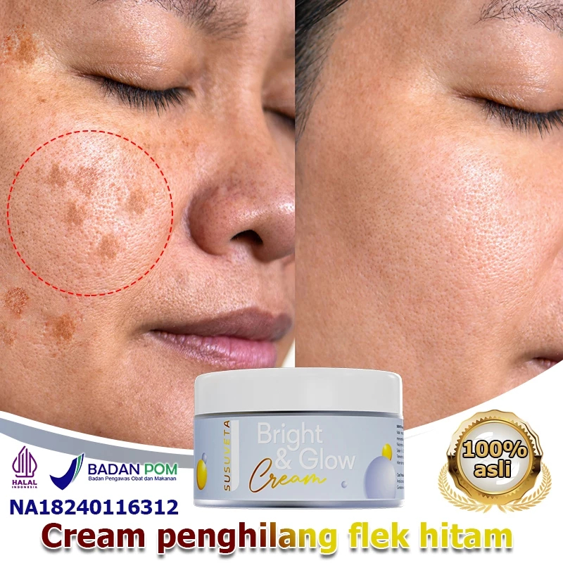 SUSUVETA Salep flek hitam membandel Cream penghilang flek hitam Cream flek hitam membandel 30g Salep