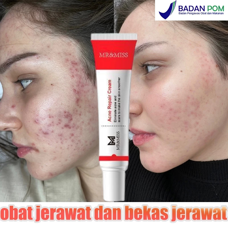 salep obat jerawat ampuh menghilangkan jerawat dan bekas jerawat