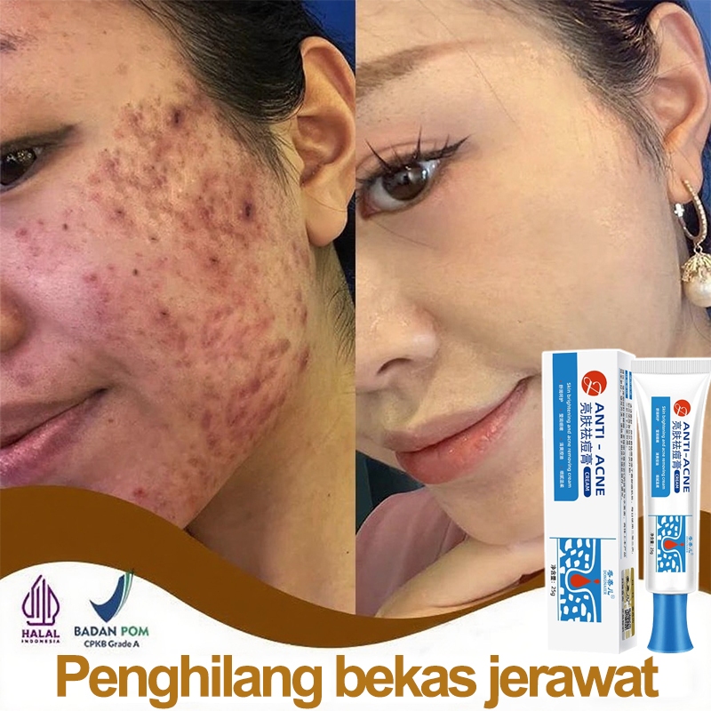 Salep Jerawat Krim Jerawat Centella Asiatica Krim Anti Jerawat 25g Penghilang Jerawat dan Bekas Luka