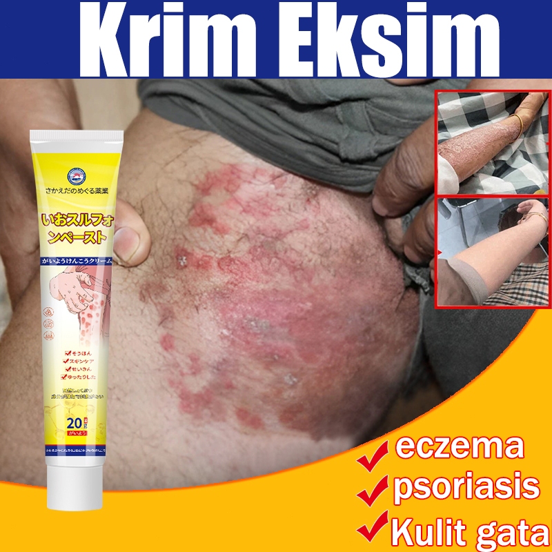 Cream gatal，psoriasis cream，salap gatal，salep gatal，saleb gatal kulit，salep buat gatal gatal ampuhsa