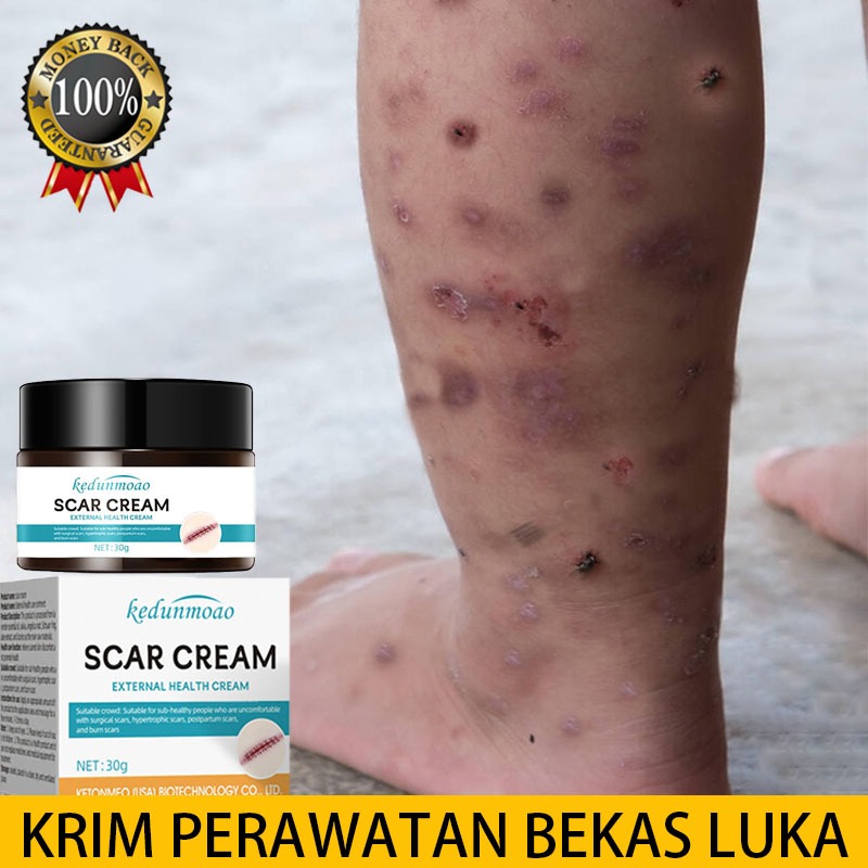 Penghilang bekas luka hitam koreng Salep bekas luka Salep penghilang bekas luka Obat penghilang beka