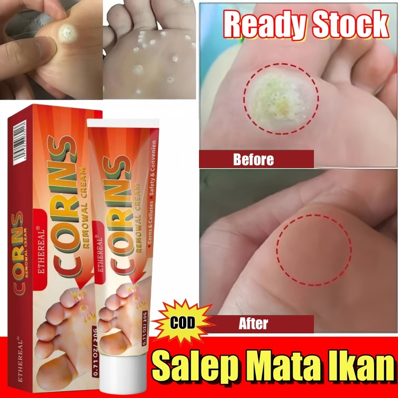 Obat Mata Ikan 20g Penghilang Mata Ikan Obat Mata Ikan Paling Ampuh Removal Corn Foot Kapalan