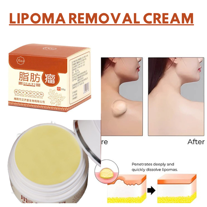 Krim Oles Penghilang Benjolan Lipoma Ampuh Lipoma Removal Cream