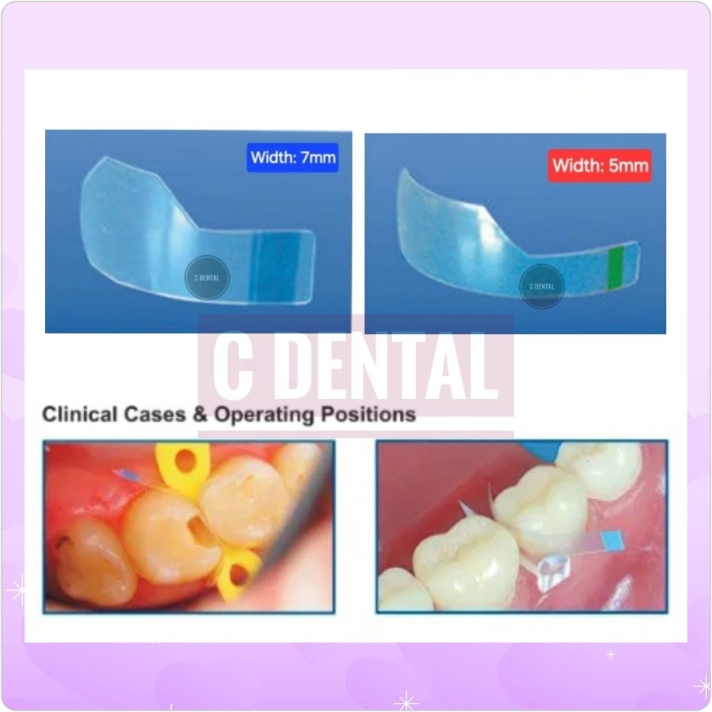 [1 Piece] Dental Posterior Proximal Matrix Transparan Strip
