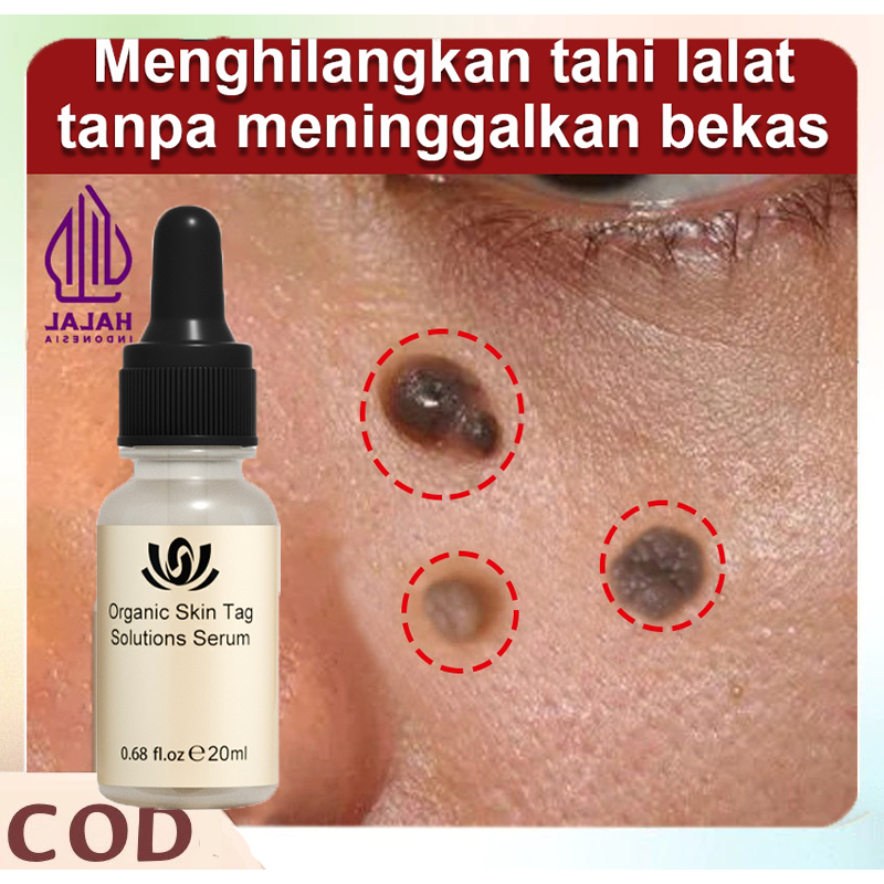 Penghilang Tahi Lalat Penghilang Kutil Wart Removal Serum Menghilangkan Tahi Lalat Skin Tag Remover 