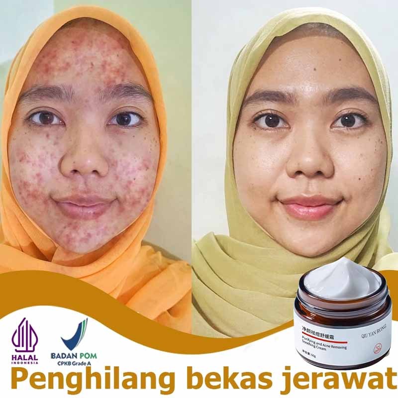 Obat jerawat cream jerawat dan bekas jerawat menghilangkan bekas jerawat 50g obat totol jerawat peng