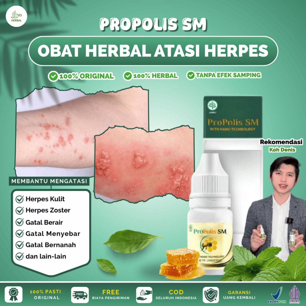 Propolis SM Untuk Herpes Kulit, Herpes Zoster, Herpes Bibir, Gatal-gatal dan Gatal Berair Menyebar B