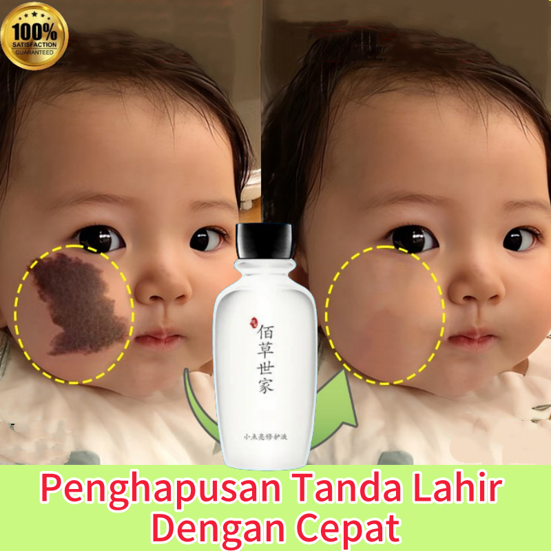 Obat Penghilang Tanda Lahir Penghilang tanda lahir coklat Hapus melanin yang diendapkan Memudarkan T
