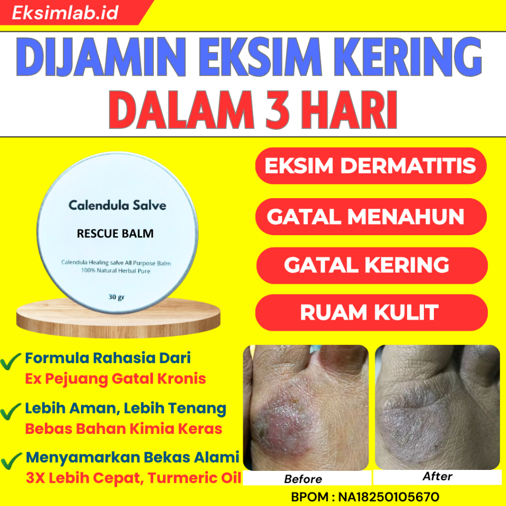 

F_daybose - Salep Herbal Eksim Obat Gatal Kulit Jamur Basah Kering Selangkangan Anak Dewasa