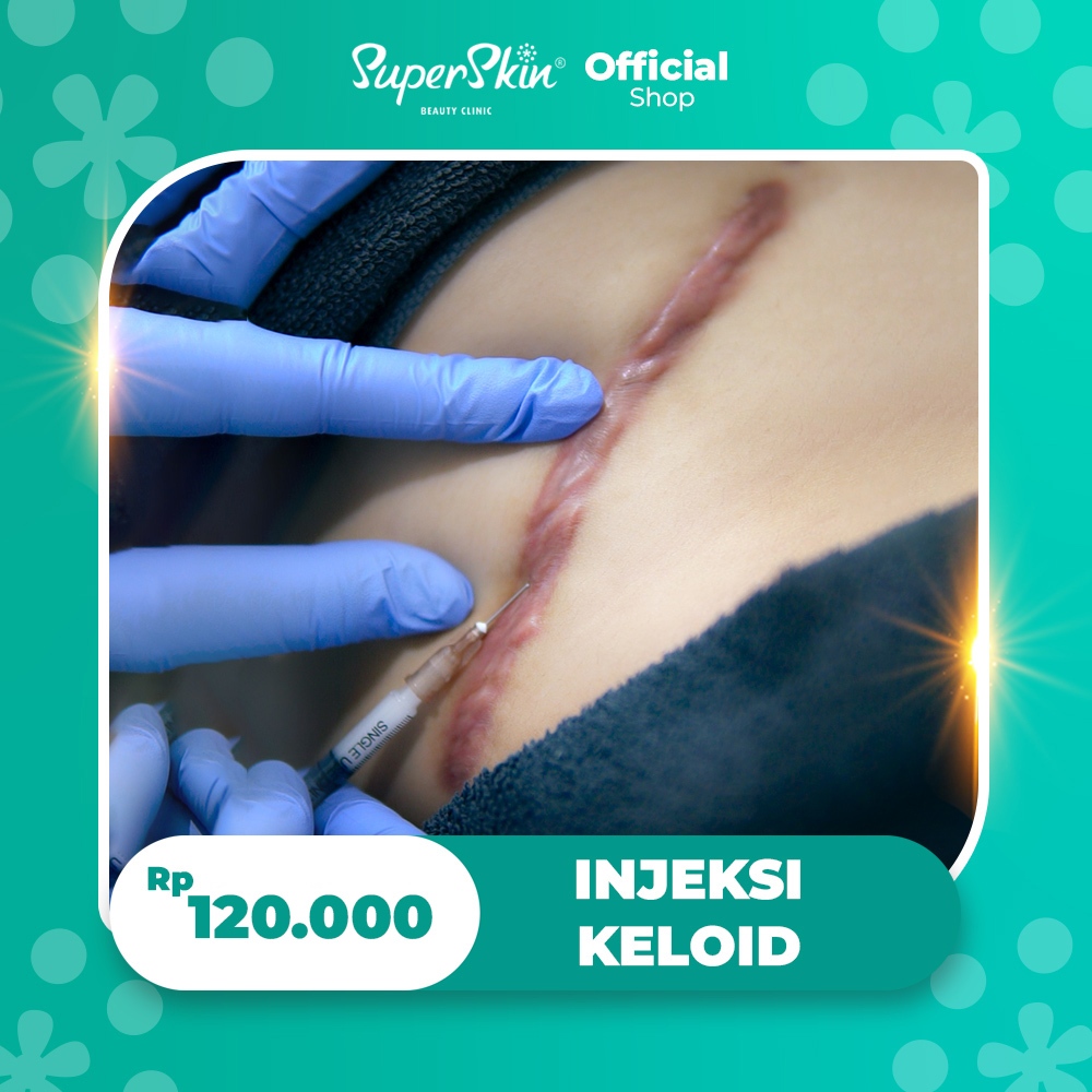 Superskin Voucher Injeksi Keloid - Menghilangkan Keloid