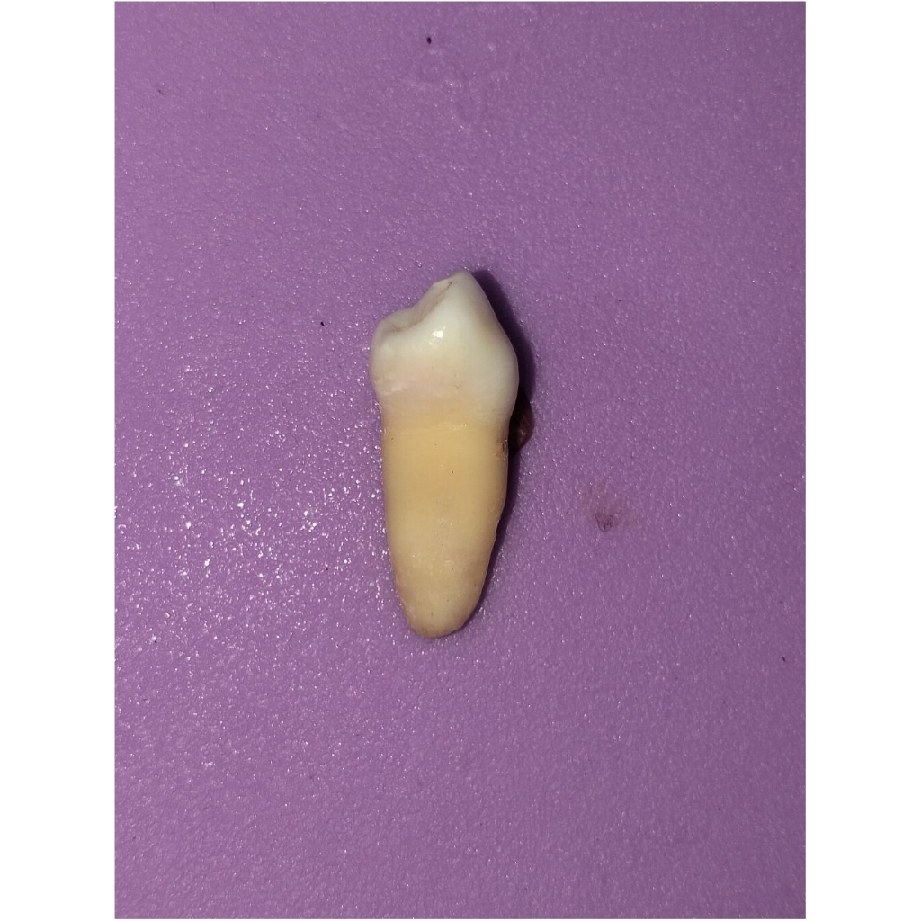 Gigi asli premolar 35