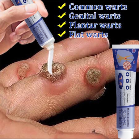 Obat kutil wart removal original salep kutil paling ampuh penghilang kutil 0bat kutil kelamin salep 