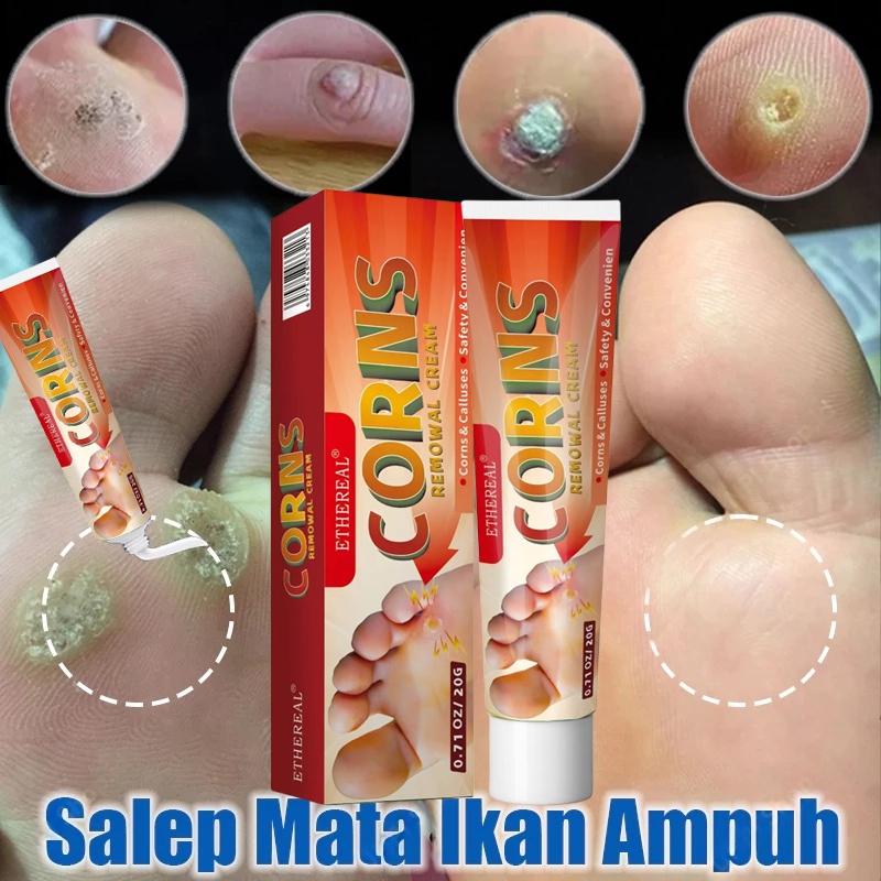 [ BISA COD ] Salep Mata Ikan Paling Ampuh 0bat Mata Ikan Di Kaki Penghilang Mata Ikan Di Tangan Foot