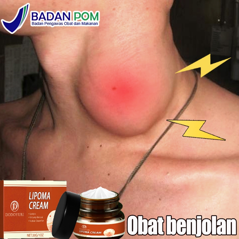 Obat benjolan obat benjolan di leher Lipoma cream original Lipoma cream salep benjolan 30g obat lipo