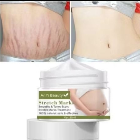 KRIM PENGHILANG STRETCH MARK