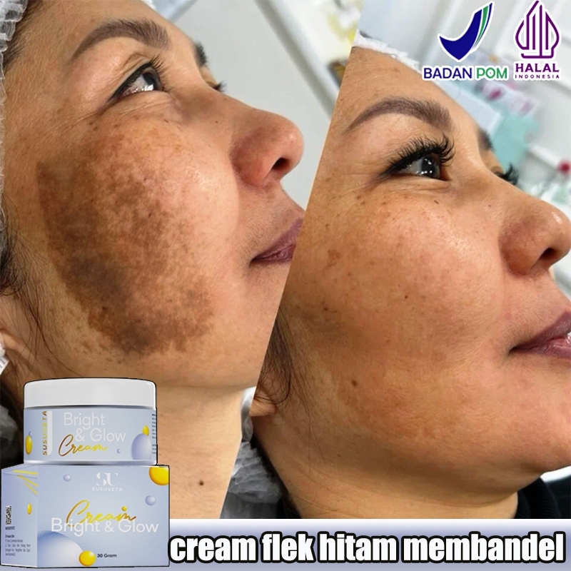 Cream flek hitam membandel Salep flek hitam membandel Krim penghilang flek hitam Menghilangkan flek 