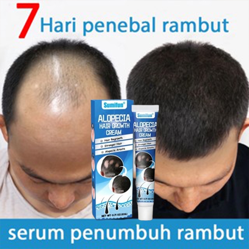 Obat penumbuh rambut Obat Alopecia Areata Rambut Pitak 20g penumbuh rambut cepat serum, penumbuh ram