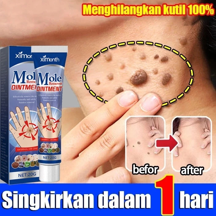 Salep Mata Ikan，0bat kutil ampuh，plester mata ikan paling ampuh，0bat mata ikan di kaki