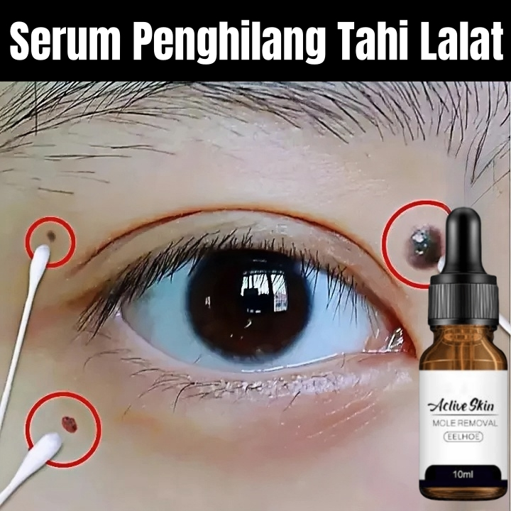 Obat Penghilang Tahi Lalat Kutil Serum Menghilangkan Tahi Lalat dan Kutil Original Menghilangkan Tah