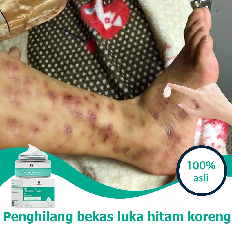 【BPOM】Cream penghilang bekas luka obat penghilang bekas luka obat keloid 30g krim penghilang bekas l