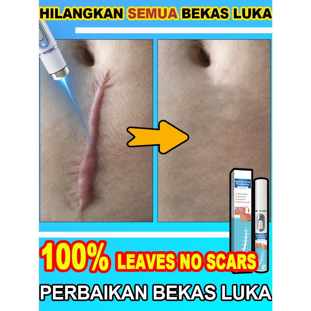 Pena penghilang bekas luka laser, menghilangkan bekas luka, memperbaiki kulit, cocok untuk luka baka