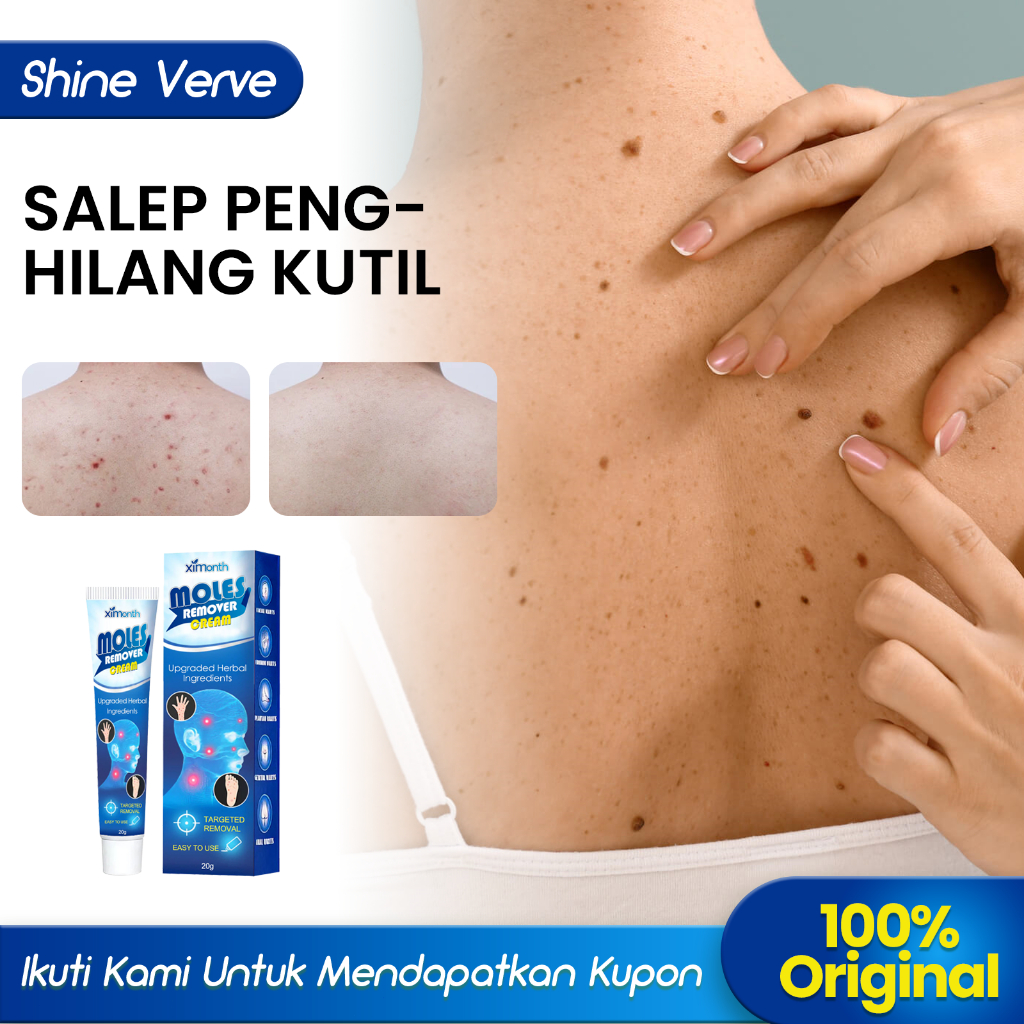 Ximonth Salep Penghilang Kutil 20g Meringankan Kutil Kulit Tahi Lalat Filamen Berdaging Kutil Pipih 