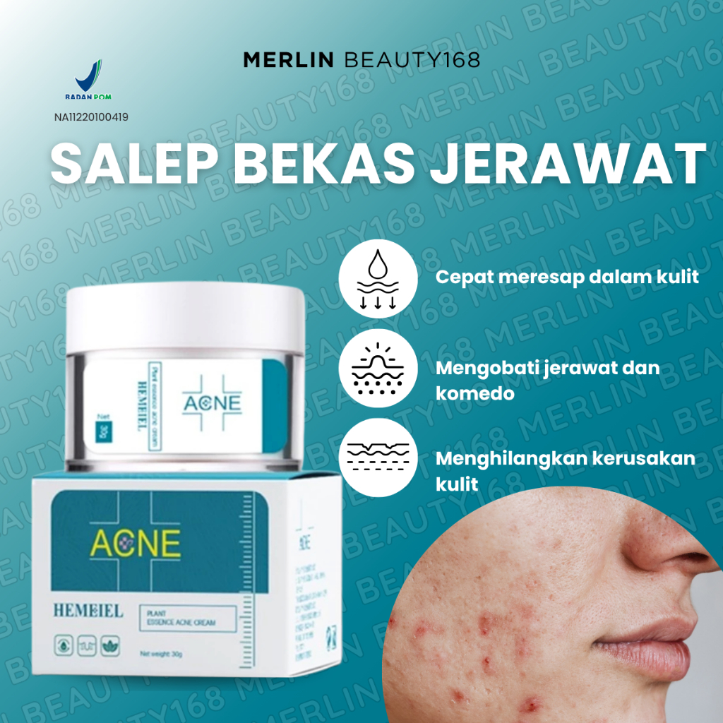 HEMEIEL - Cream Penghilang Bekas Jerawat Kemerahan (PIE) & Kehitaman (PIH) | Krim Salep Bekas Jerawa