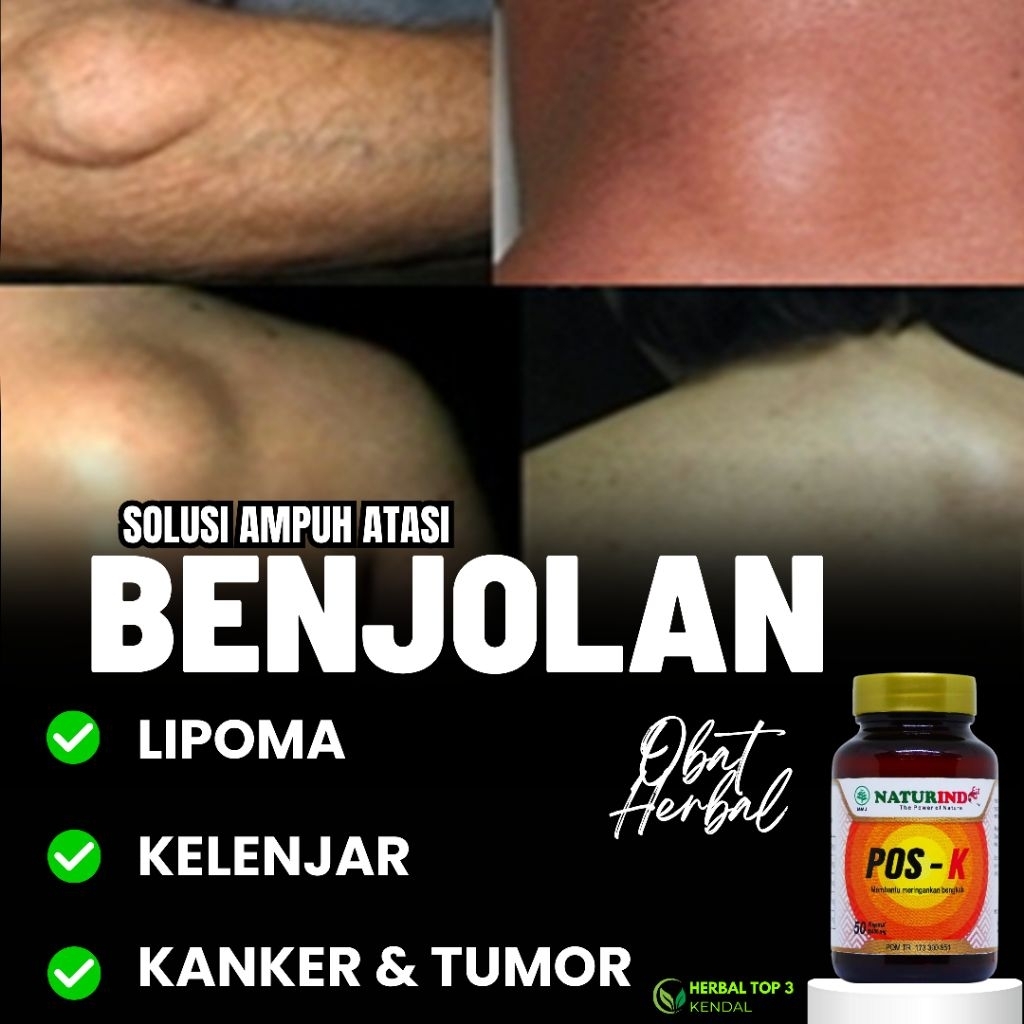 Obat Benjolan Herbal Lipoma Payudara Kelenjar Leher Ketiak