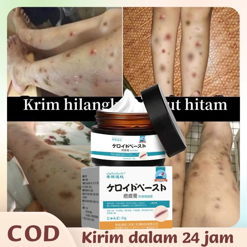 Bekas Luka Jahitan, Gigitan Serangga, Bekas Luka Kaki, Luka Bakar, Bekas Luka Stretch Mark, Bekas Lu