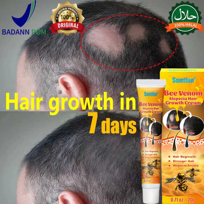 Obat Alopecia Areata 20g Alopecia Hair Growth Cream Penumbuh Rambut Botak Koin Pria Dan Wanita Penyu