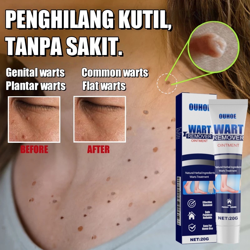 【Bisa COD】Salep Obat Kutil 20g Obat Kutil Paling Ampuh Kutil Leher Penghilang Kutil Wajah