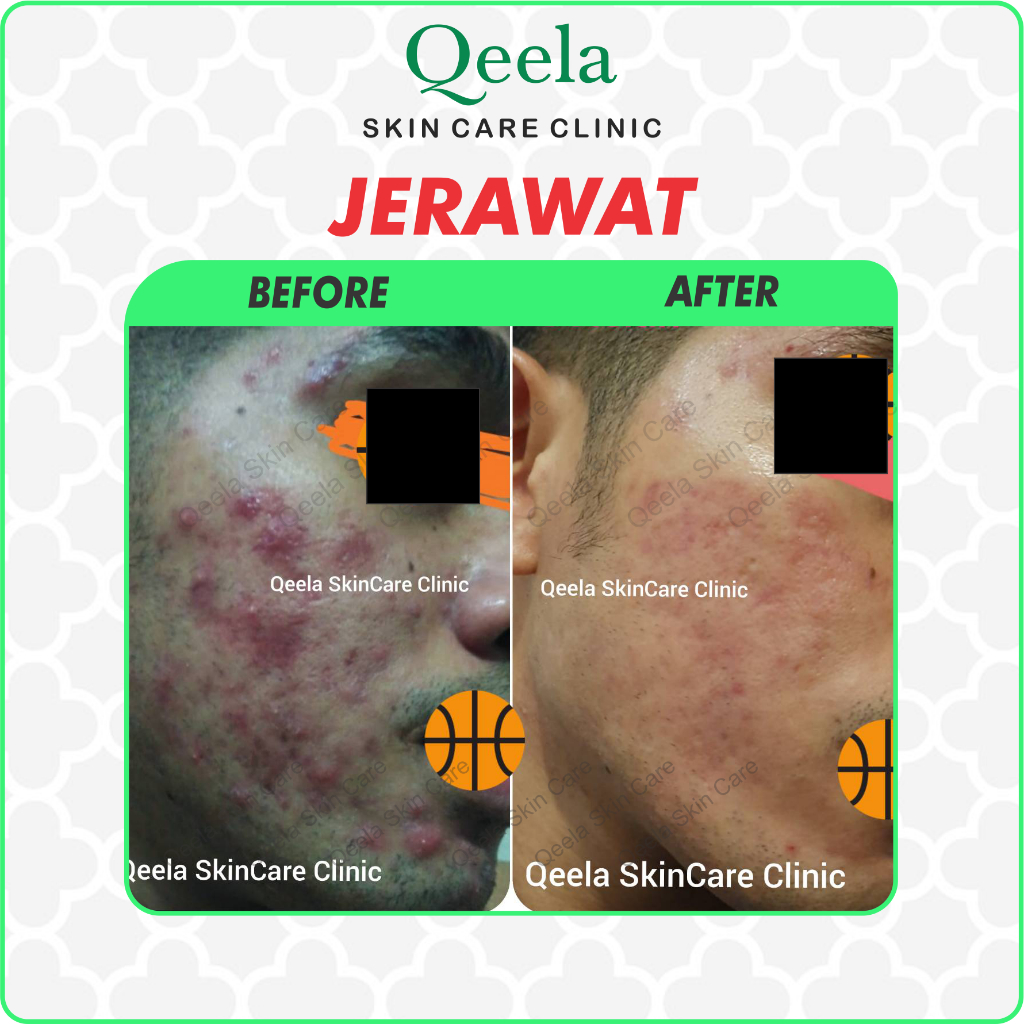 Cream Jerawat Pagi Malam – Qeela Skincare – Untuk Remaja & Dewasa – BPOM & Tidak Menyumbat Pori