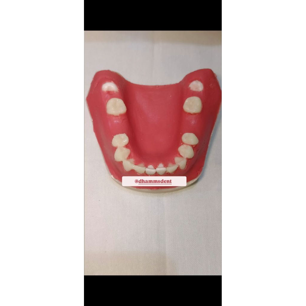 Model Gigi Odontektomi, Implan, dan Avulsi