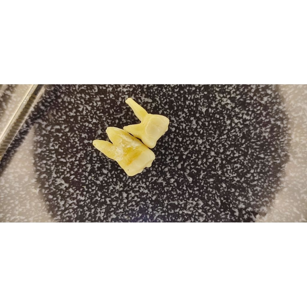 gigi asli gigi molar anak akar dan molar dewasa rahang bawah