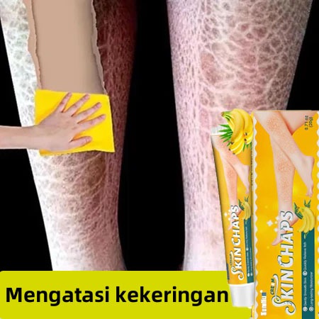 Obat gatal kulit Salep eksim Iktiosis Iktiosis kulit Obat jamur kulit Salep kulit 20g Krim kaki peca