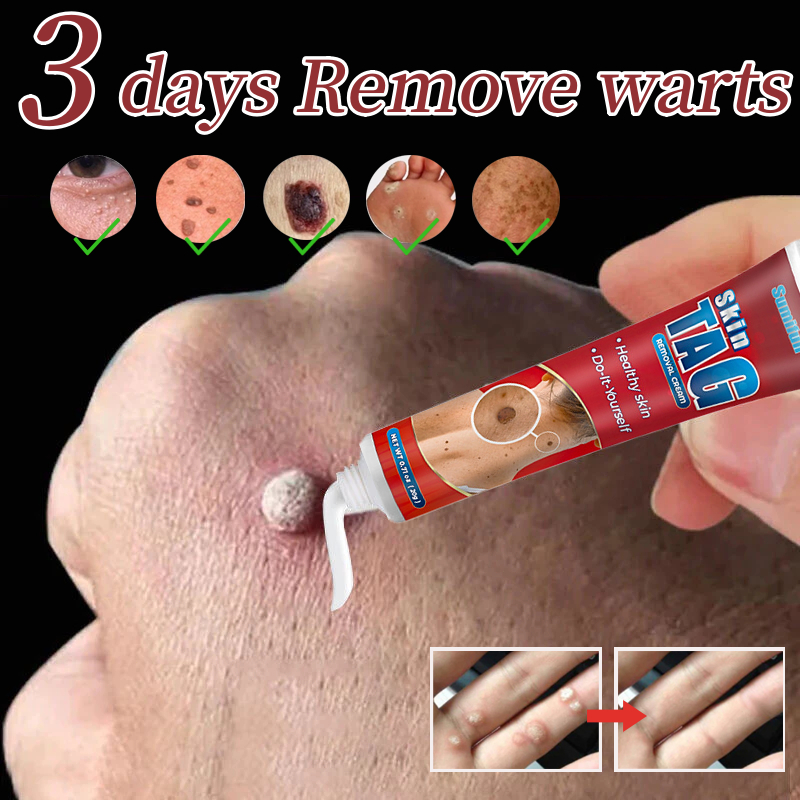 Krim Kutil Menghilang kutil intim kutil leher kutil leher wajah daging kulit skin tag ketiak Keloid 
