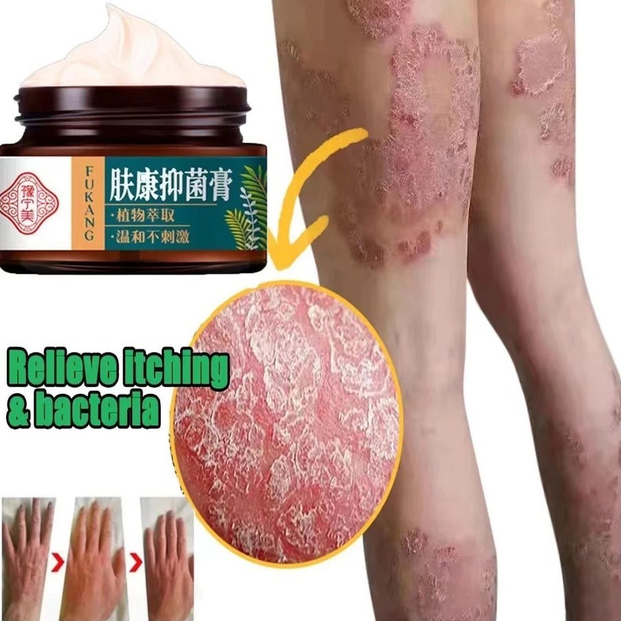 CREAM SALEP PENGHILANG GATAL GATAL KULIT PALING AMPUH OBAT SALAP GATEL DERMATITIS PSORIASIS EKSIM PA