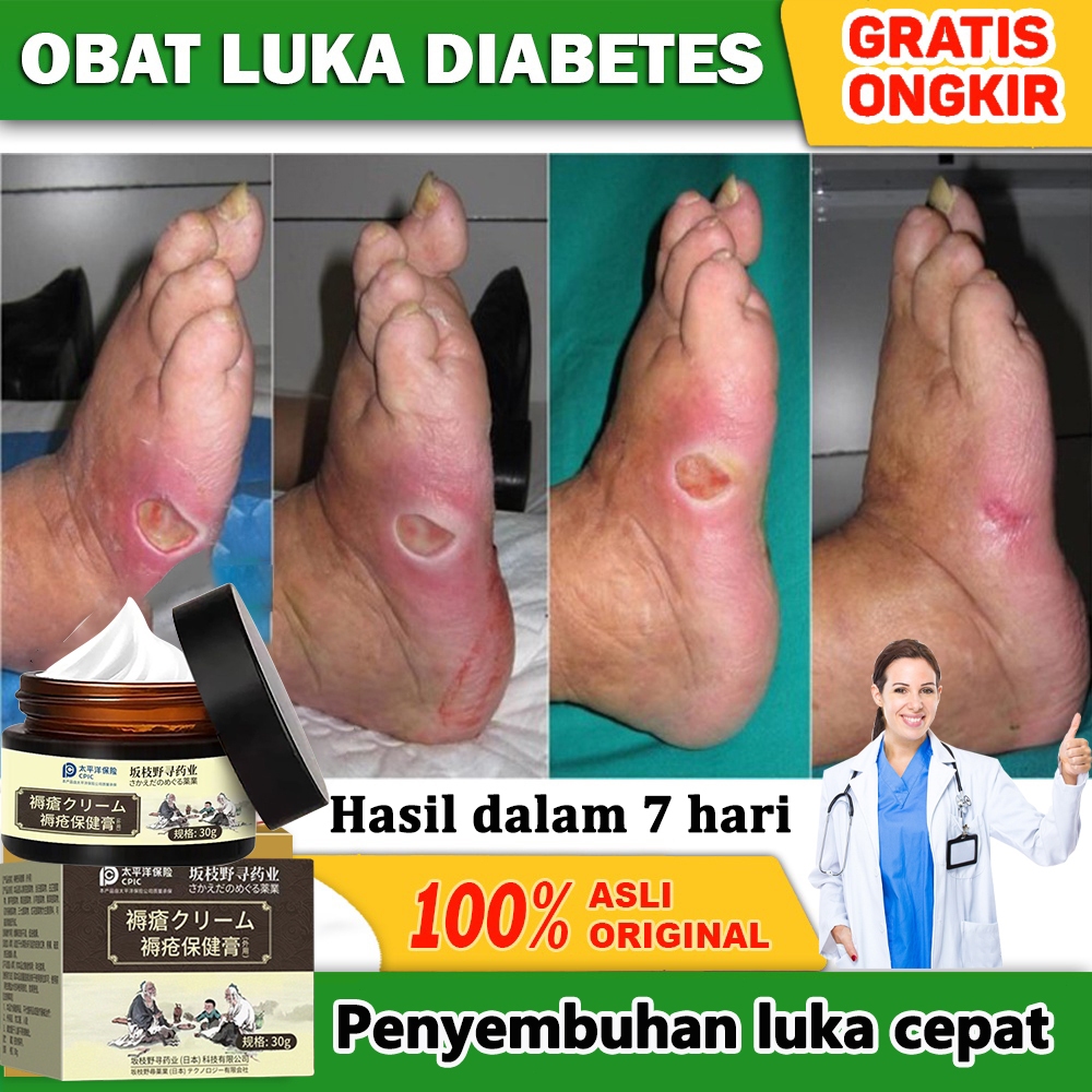 Krim Luka Baring Obat Luka Diabetes, Obat Luka Diabetes Luka Penyembuhan, Salep Luka Cepat Kering 30