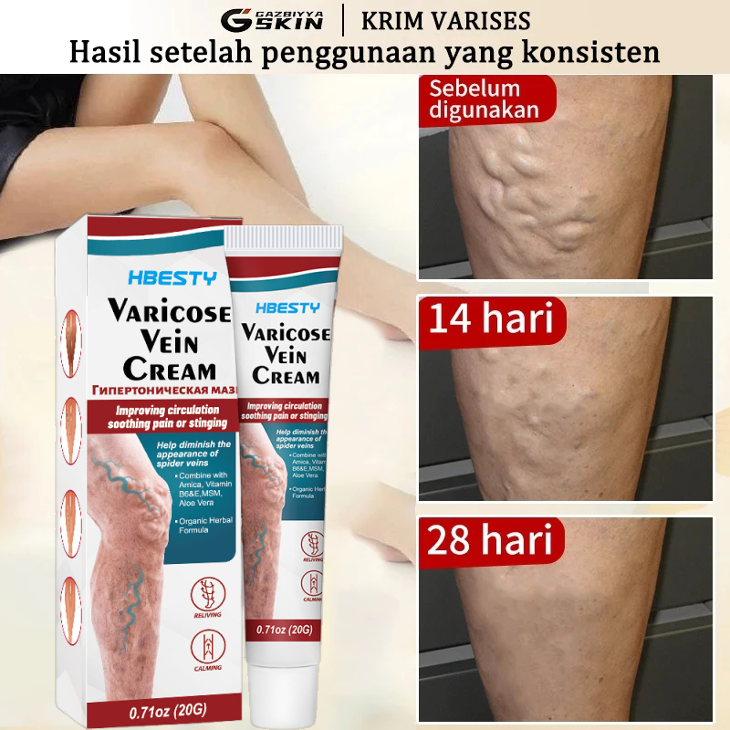 100% Asli Obat Varises Asli 20g Salep Penghilang Varises Ampuh Obat Varises Original Obat Varises Di