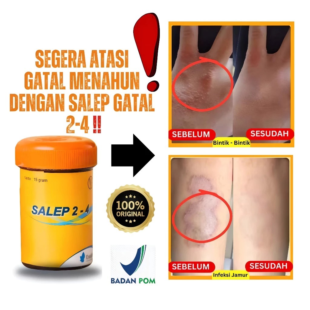 Terlaris Salep Gatal Zwafel 24 Original Asli Obat Salep Gatal Panu Kadas Kurap Kutu Air Original