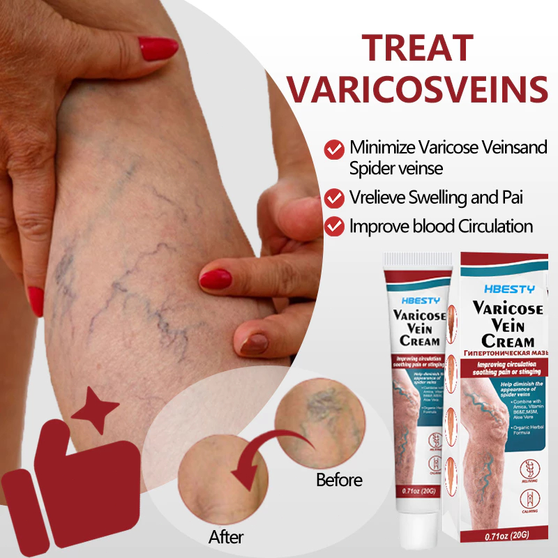100% Asli Obat Varises Asli 20g Salep Penghilang Varises Ampuh Obat Varises Original Obat Varises Di