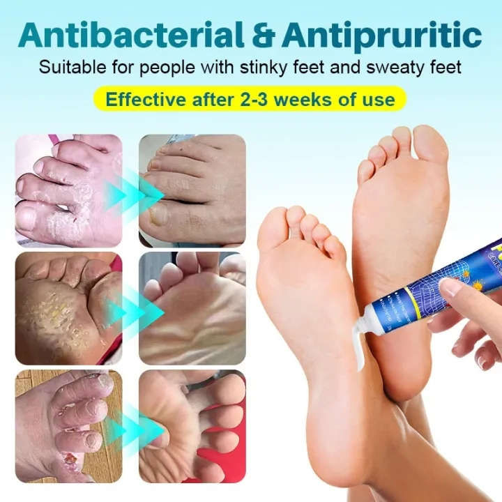 Pengobatan jari kaki merayap, pengobatan depresi plantar, pengobatan keratolisis pitting