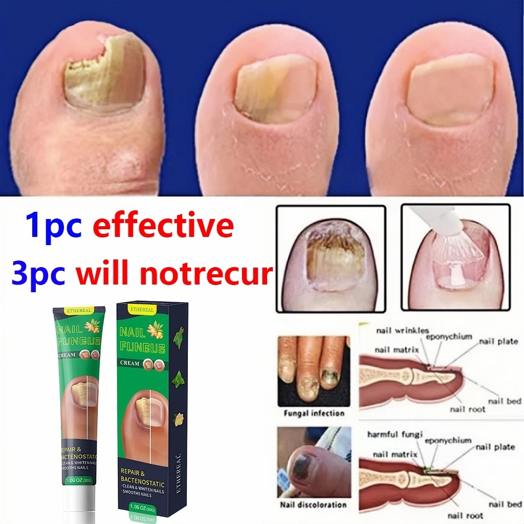 Obat Kuku Kaki Jamur Dan Rusak Perawatan Jamur Kuku Pemutih Kuku Penghilang Jamur Kuku Gel Anti