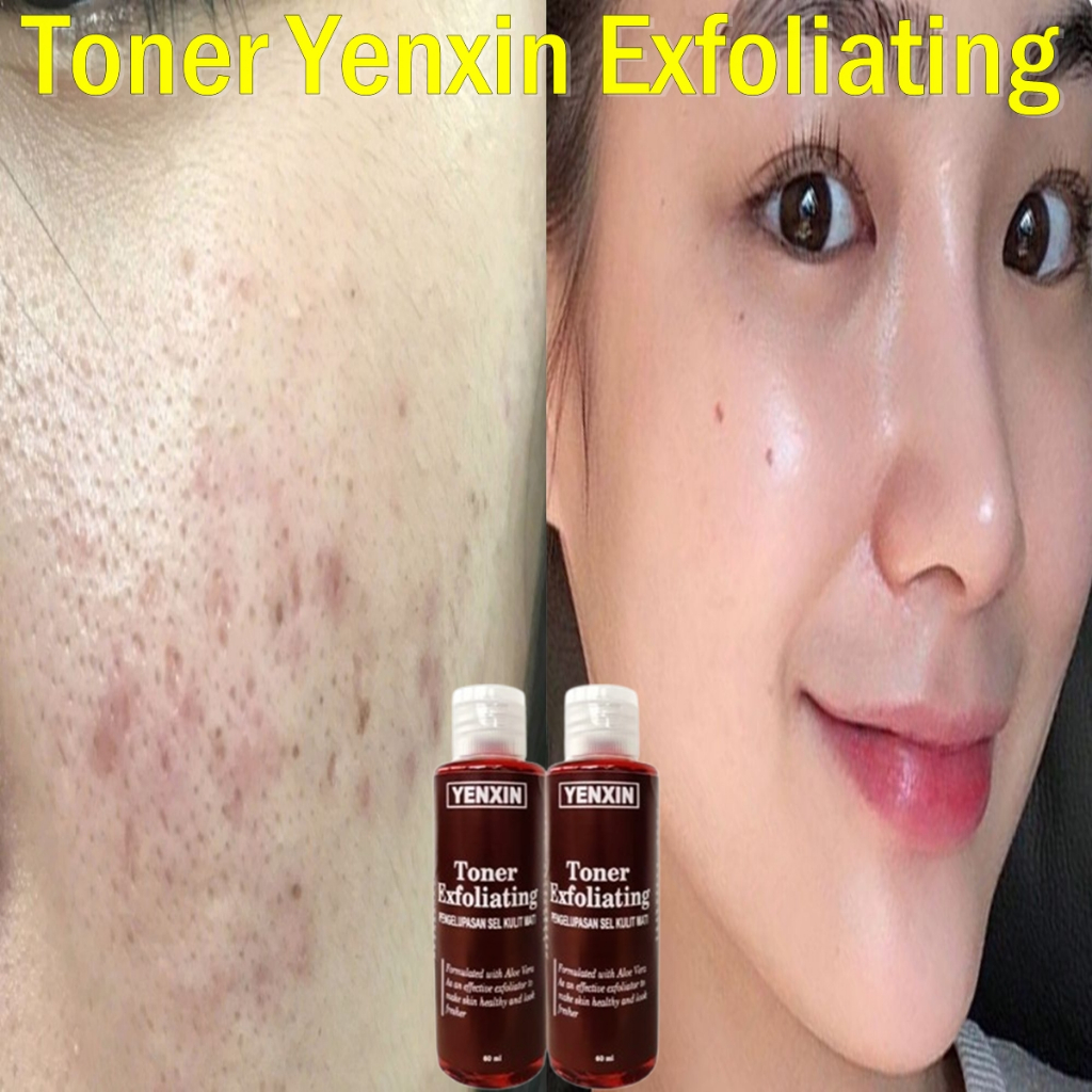 toner flek hitam [READY STOK] Kemasan Dosis Tinggi Toner Flek BPOM Penghilang Flek Noda Bintik Hitam