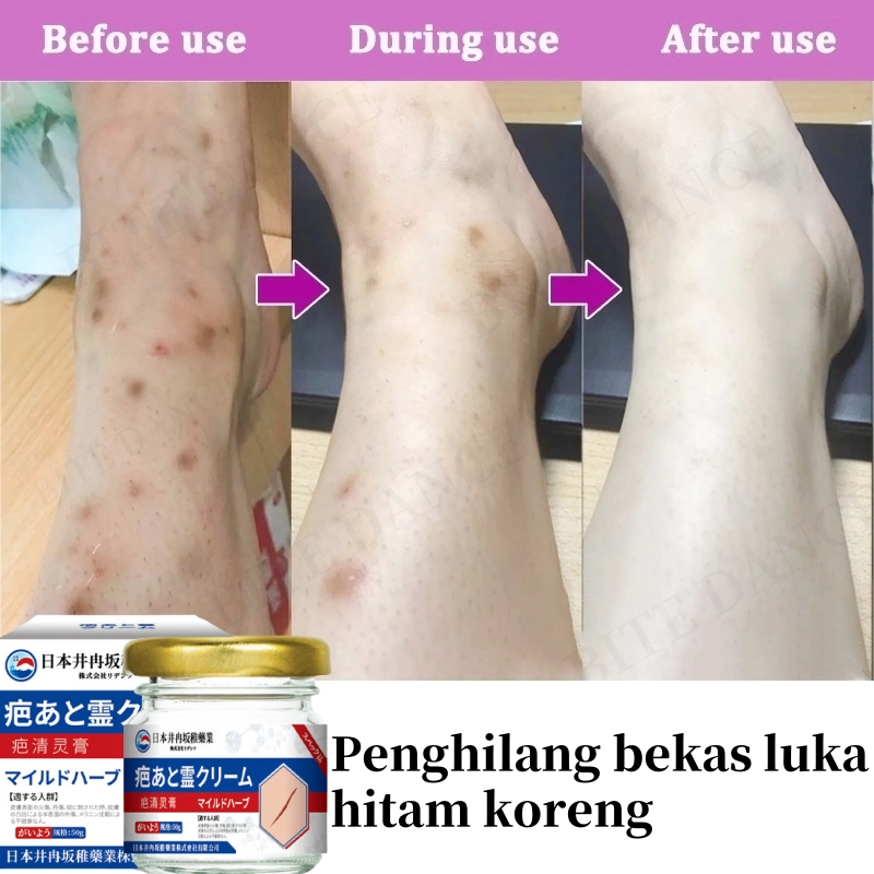 Penghilang bekas luka hitam koreng Penghilang bekas luka di kaki Bekas luka bakar Bekas lama Keloid