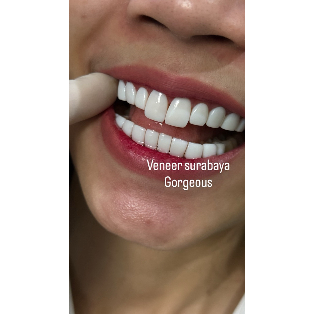 VENEER DIRECT VENEER GIGI