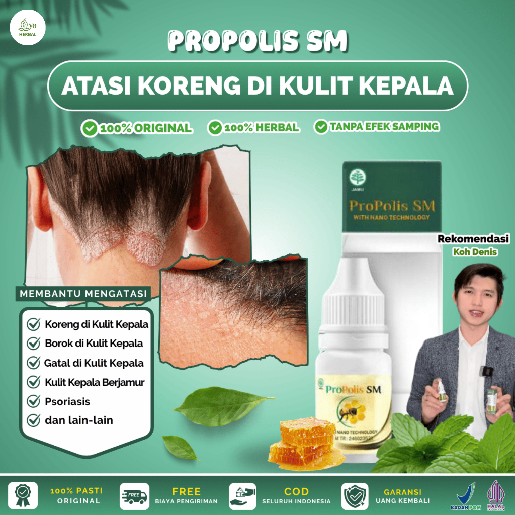Propolis SM Untuk Koreng di Kulit Kepala, Psoriasis, Borok di Kulit Kepala, Kulit Kepala Berjamur, I