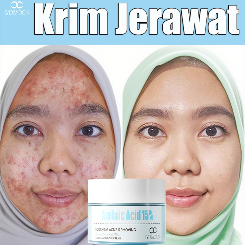 Krim Jerawat 30g untuk Jerawat Parah, Jerawat Berjerawat, Bekas Jerawat, Bopeng, Penghilang bopeng