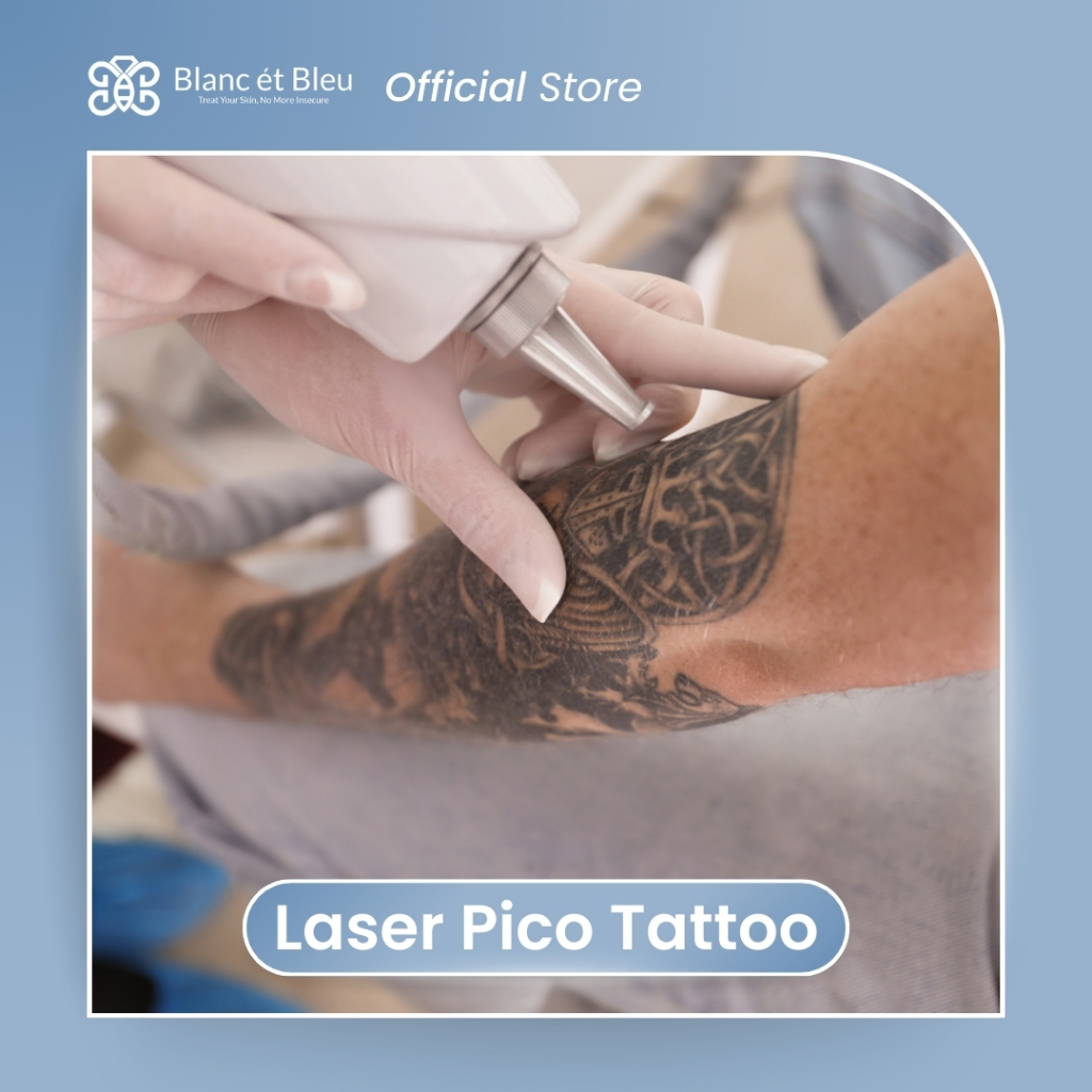 Laser Pico Tattoo