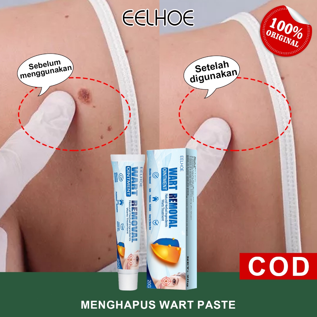 EELHOE [Beli 3 Gratis 2/ORI] Wart Removal Cream 20g Salep Penghilang Kutil Dan Tahi Lalat Ampuh Krim